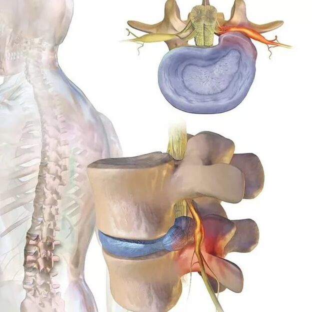 បញ្ហានៃឌីស intervertebral