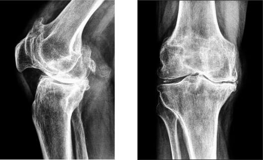 Gonarthrosis នៃជង្គង់នៅលើកាំរស្មីអ៊ិច