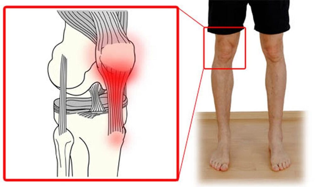 Tendinitis - ការរលាកនៃសរសៃពួរនៅក្នុងសន្លាក់ជង្គង់