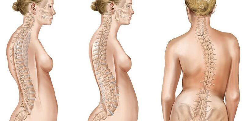 Scoliosis នៃឆ្អឹងខ្នង thoracic បង្កឱ្យមានរូបរាងនៃការឈឺចាប់នៅក្នុង blades ស្មា