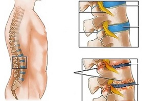 មូលហេតុនៃជំងឺ osteochondrosis នៃឆ្អឹងកងខ្នងចង្កេះ