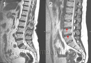 osteochondrosis កឆ្អឹងខ្នង